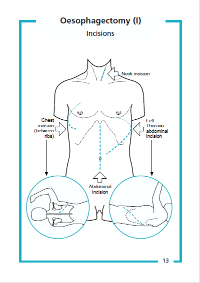 Guide to Upper GI Surgery