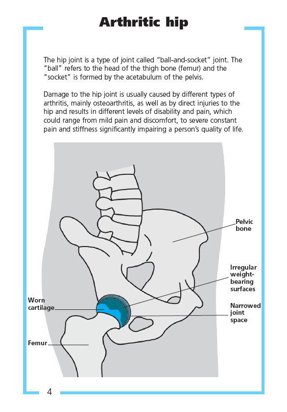 Guide to Joint Replacement